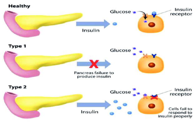 Insulin Resistance Diabetes