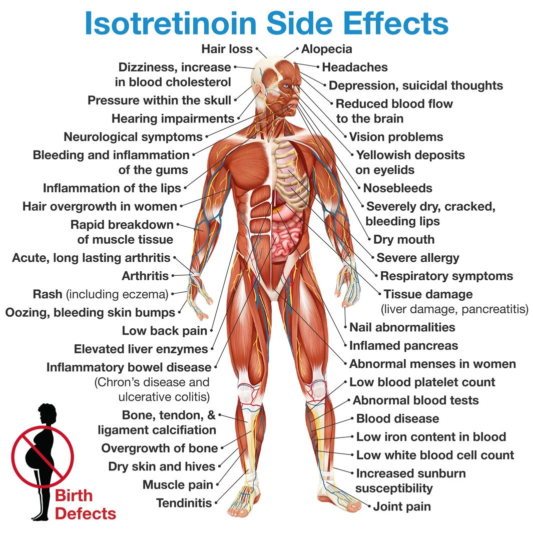 Isotretinoin (Accutane) Side Effects