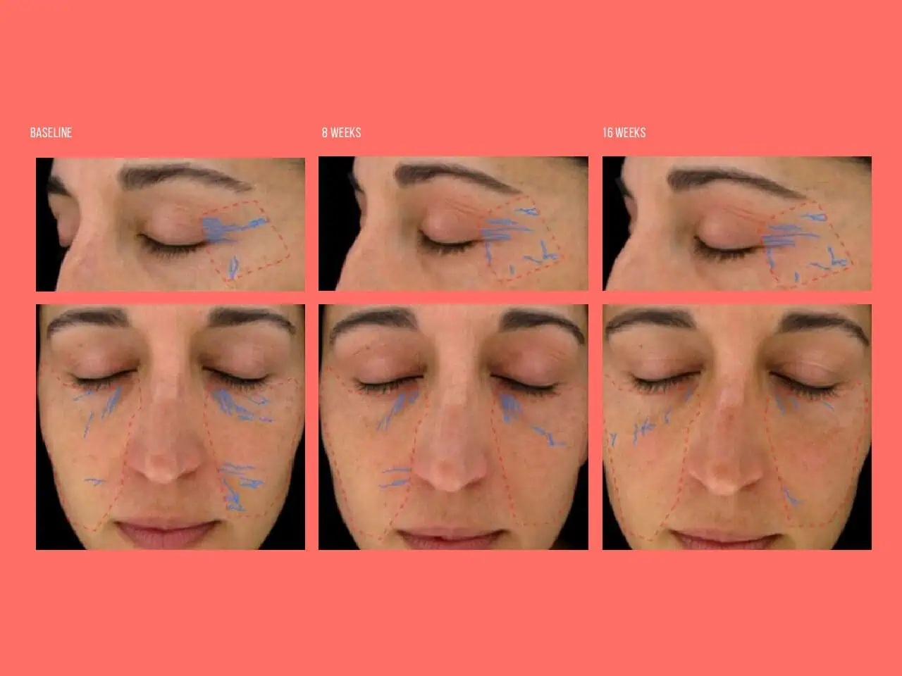 OptiMSM Skin Wrinkle Reduction Over 16 Weeks